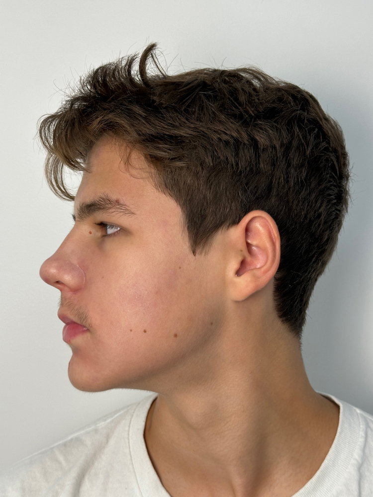 After acne facial treatment with smoother skin texture at Darlings Beauty Lab in NoMad, NYC