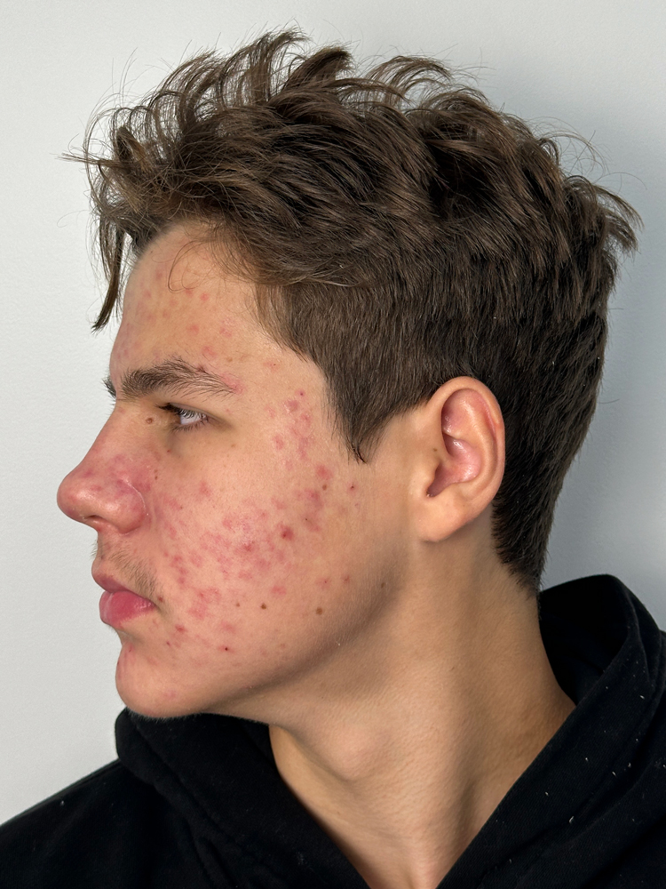 Before deep pore cleansing facial for acne-prone skin at Darlings Beauty Lab