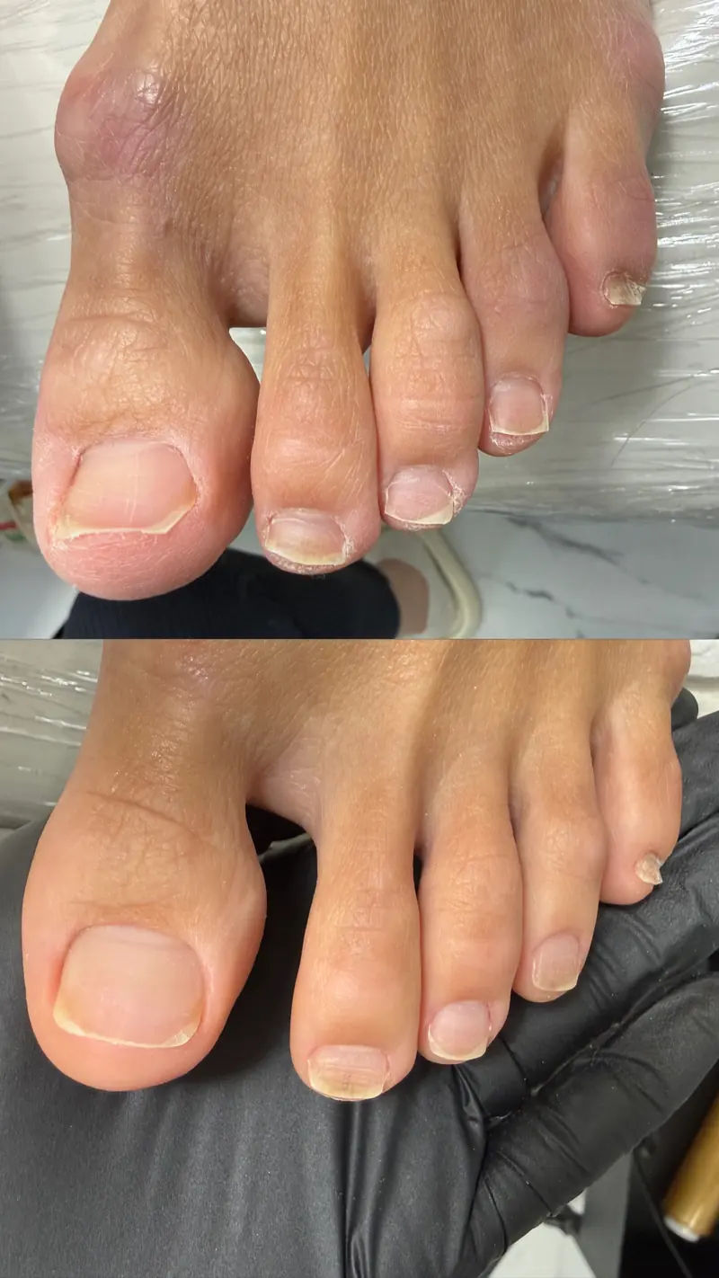 Before and after SMART Pedicure result in Manhattan