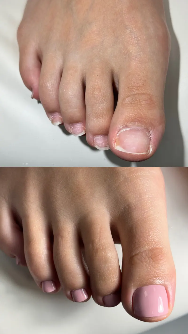 Before and after SMART Pedicure result in NYC
