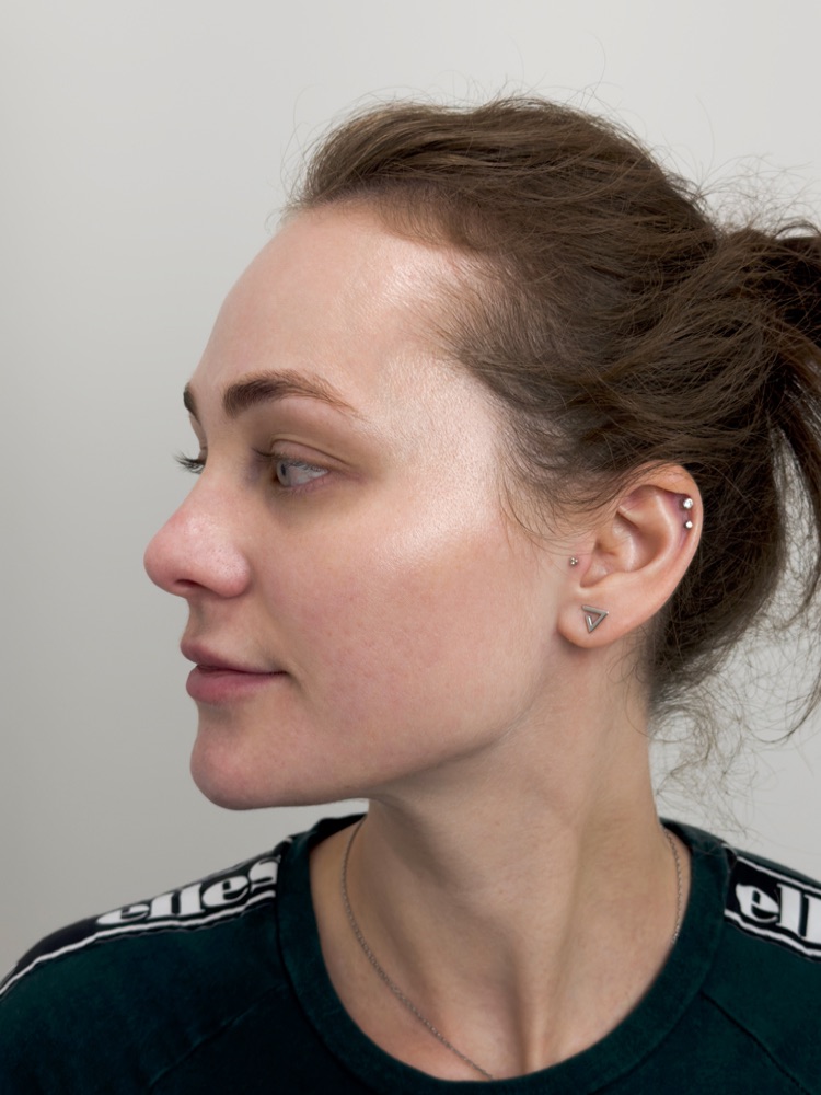 After microneedling treatment with smoother skin texture in NoMad, Manhattan
