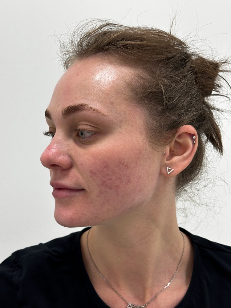Before microneedling treatment for texture and acne marks in NoMad, Manhattan